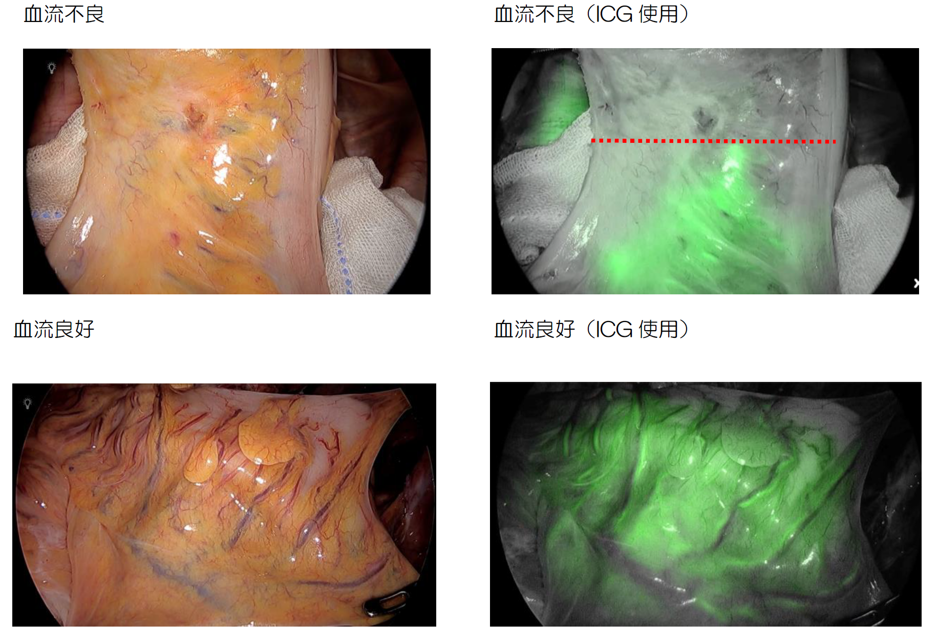 <ICGを用いた腸管血流イメージ>